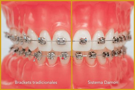 brackets damon esteticos o metalicos|ortodoncia y brackets.